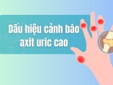 6 dấu hiệu cảnh báo axit uric tăng