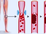 Huyết khối tĩnh mạch sâu là gì?