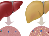 Làm thế nào đảo ngược tình trạng gan nhiễm mỡ