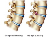 Thoát Vị Đĩa Đệm Cột Sống