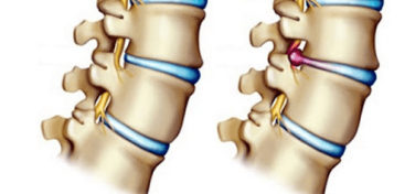 Thoát Vị Đĩa Đệm Cột Sống