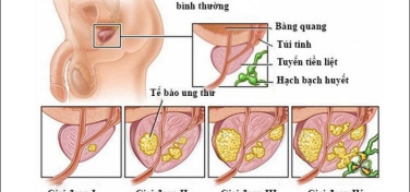 Ung thư tuyến tiền liệt xảy ra khi nào?