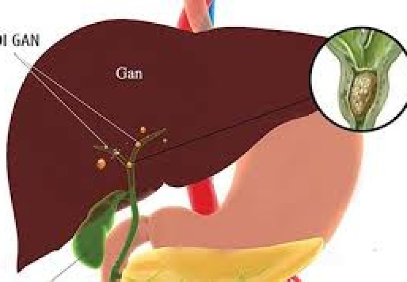 Sỏi gan là gì?