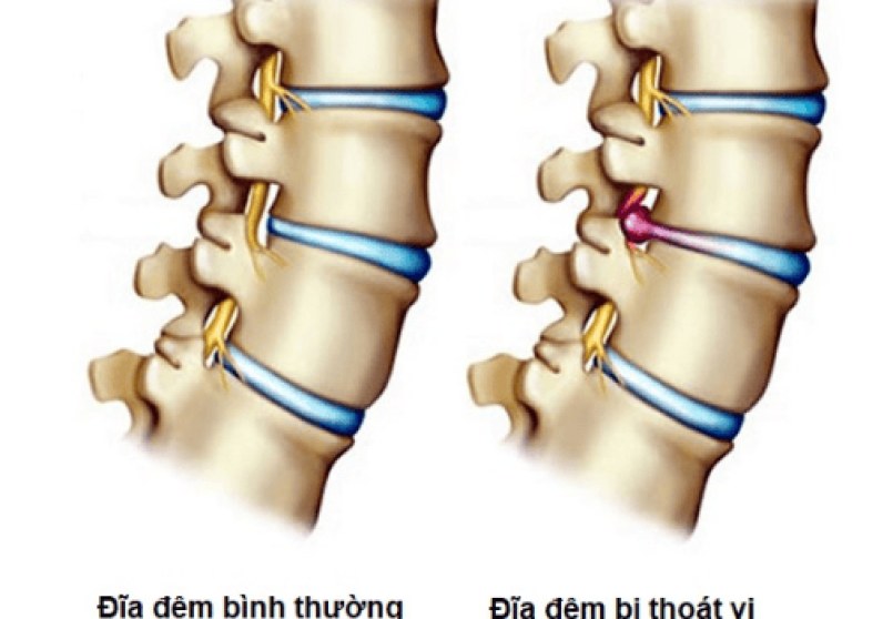 Thoát Vị Đĩa Đệm Cột Sống